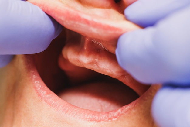 Close-up de um paciente irreconhecível com falta de dentes preparando-se para implantação de dentes em uma clínica odontológica.