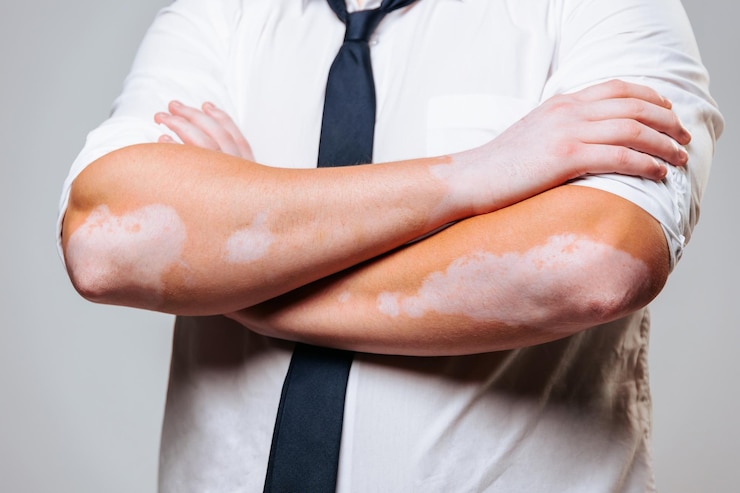 Foto close-up de uma mão humana com manchas simétricas de vitiligo na pele vestido com uma camisa e gravata significa sucesso na vida fundo cinza estúdio tiro terno irreconhecível
