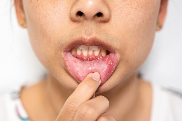 Foto close-up de uma mulher asiática com úlcera aftosa ou aftas na boca no lábio