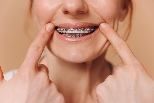 Close-up de uma mulher estendendo um sorriso com os dedos e mostrando seus aparelhos ortopédicos