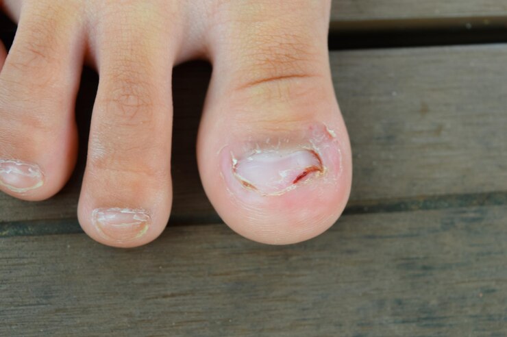 Foto close-up de uma perna com um fungo nas unhas onicólise esfoliação da unha do leito ungueal
