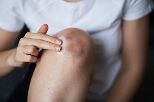 Close-up de uma pessoa esfregando creme para curar a articulação do joelho ferido. Hematoma no joelho. Dor na perna.