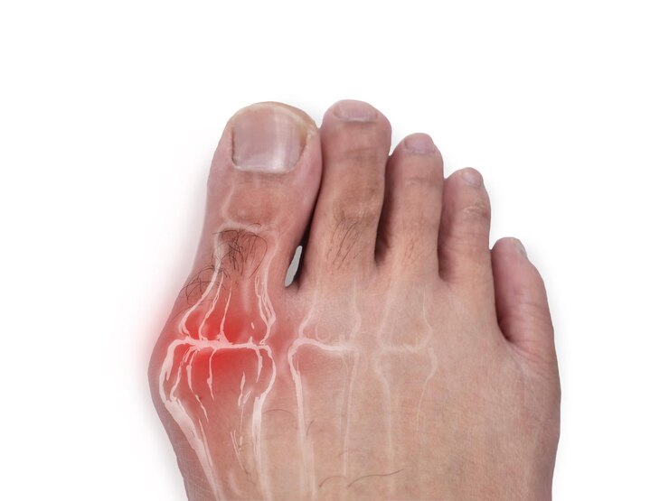 Close up do pé com problema de bunion hallux valgus dedos dos pés humanos com inflamação vermelha