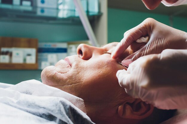 Foto close-up do procedimento para lifting facial pdo operação de sutura cirurgia de lifting face técnica inovadora de novo levantamento de fios novathreads e silhouette instalift bolsas masculinas sob os olhos