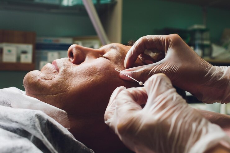 Foto close-up do procedimento para lifting facial pdo operação de sutura cirurgia de lifting face técnica inovadora de novo levantamento de fios novathreads e silhouette instalift bolsas masculinas sob os olhos