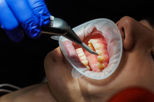 Foto close-up dos dentes, check-up odontológico no consultório odontológico. o dentista examina os dentes do paciente com instrumentos dentários. odontologia. foco seletivo