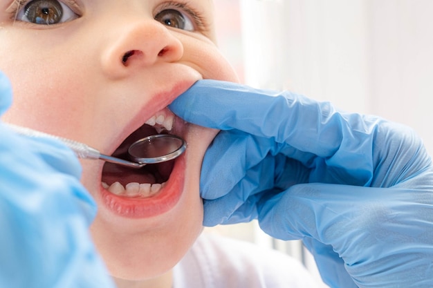 Closeup boca aberta criança e espelho nas mãos dos dentistas no exame de luvas azuis examinam o tratamento dos dentes para cuidados de saúde infantil higiene dental das crianças