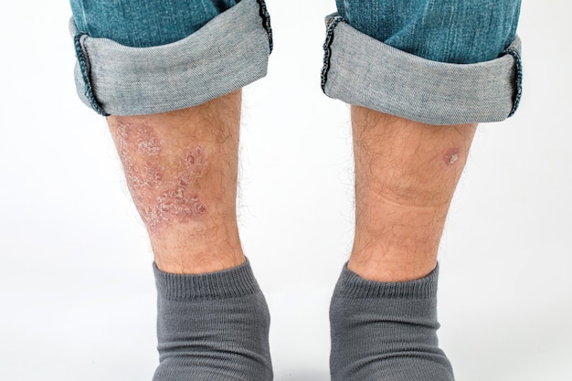 Closeup das pernas de um homem que sofre de psoríase crônica em um fundo branco