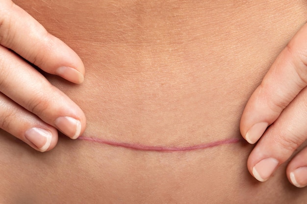 Closeup de cicatriz após cirurgia de cesariana na barriga feminina