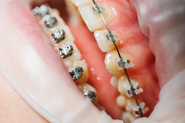 Closeup de dentes com aparelho de metal Tratamento ortodôntico da mandíbula