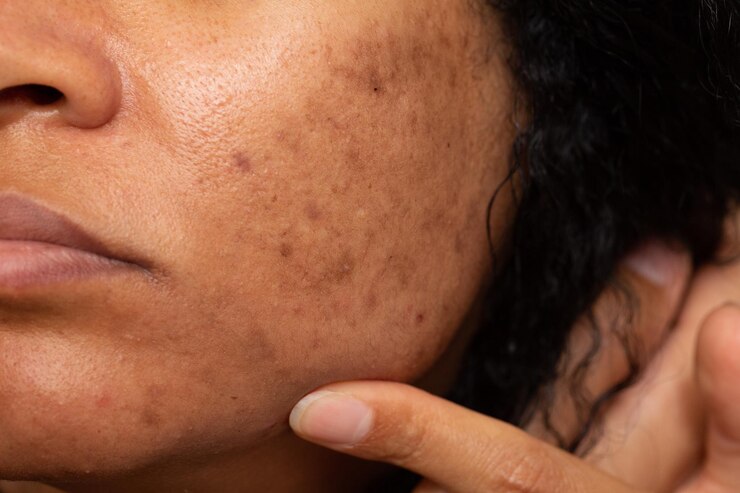 Foto closeup de mulher asiática com manchas escuras e problemas de sardas