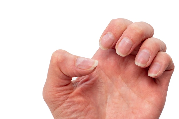 Closeup de unhas quebradiças mão feminina em um fundo branco isolado Unhas problemáticas unhas naturais não tratadas