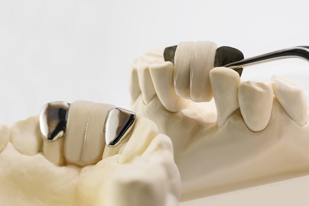 Closeup Dental maryland Bridge Equipo de corona y puente y restauración de corrección rápida modelo