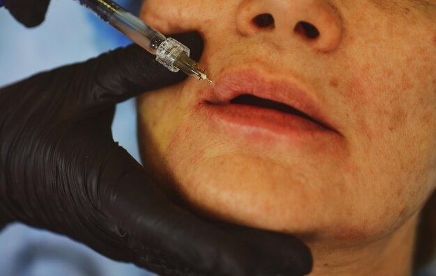 Closeup Frau Lippen Verfahren Augmentation Spritze weiblichen Mund Hyaluronsäure Injektion Augmentatio