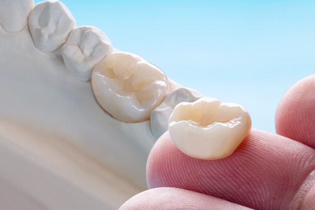 Closeup / Prótese ou Prótese / Equipamento de coroa e ponte de dente unitário modelo de restauração de fixação expressa.