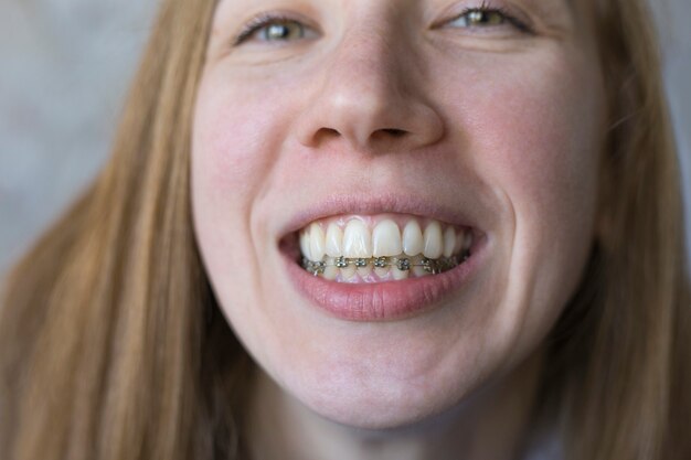 Foto closeup retrato de niña sonriente con tirantes metálicos en la mandíbula inferior alineación de los dientes dientes torcidos