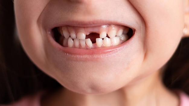 Closeup Uma linda garota engraçada sem um dente de bebê Um sorriso sem dentes Um dente de leite caiu Foco seletivo