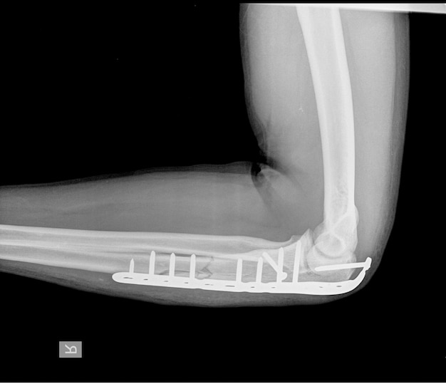 Codo Una fractura de olécranon se puede sujetar con placa y tornillos.