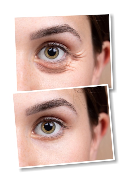 Colagem de vistas de close-up dos olhos da mulher Comparação de antes e depois da intervenção de cuidados de beleza Conceito de saúde e cuidados com a pelexDxA