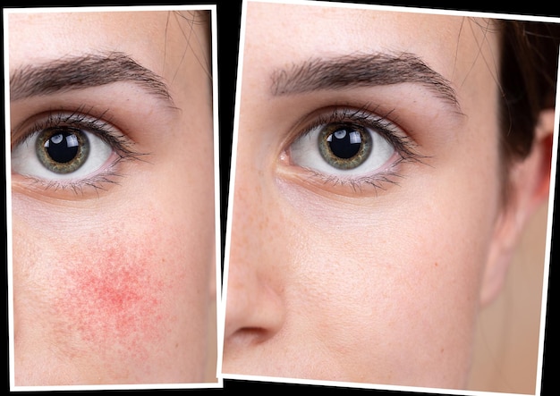 Collage-Vergleich gesunde Haut und Haut, die an Rosacea leidet Junge weibliche Gesicht Nahaufnahme Medizin und GesundheitskonzeptxDxA