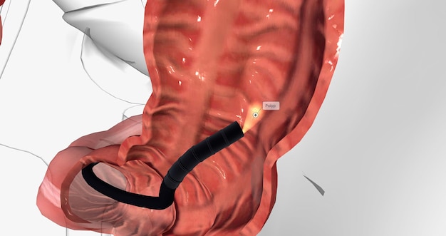 La colonoscopia se usa más comúnmente para la detección del cáncer colorrectal.
