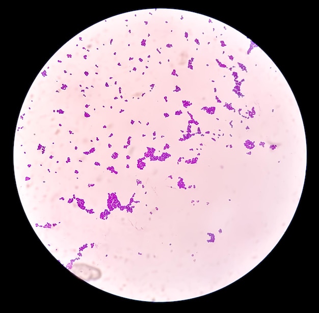 Coloração de Gram sob visão microscópica mostrando colônia de Candida ou Candida albicans