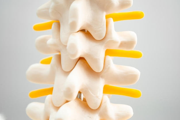 Columna lumbar desplazada fragmento de disco herniado nervio espinal y modelo óseo para tratamiento médico en el departamento de ortopedia