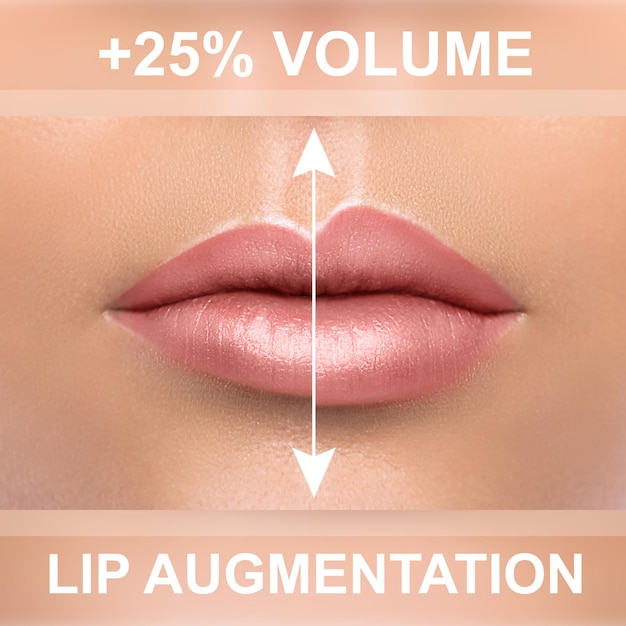 Comparación de labios femeninos después del aumento con inyecciones de relleno.