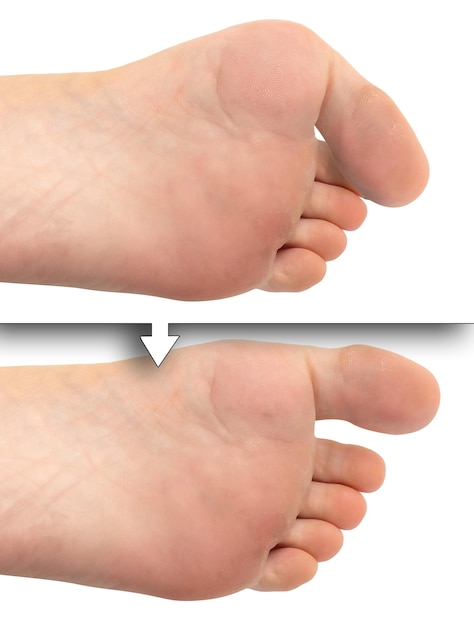 Comparación entre pies con y sin juanete