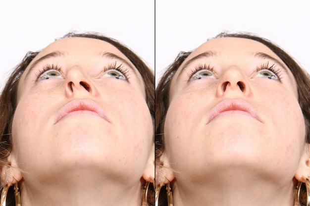Una comparación entre los resultados de la reconstrucción de la nariz antes y después