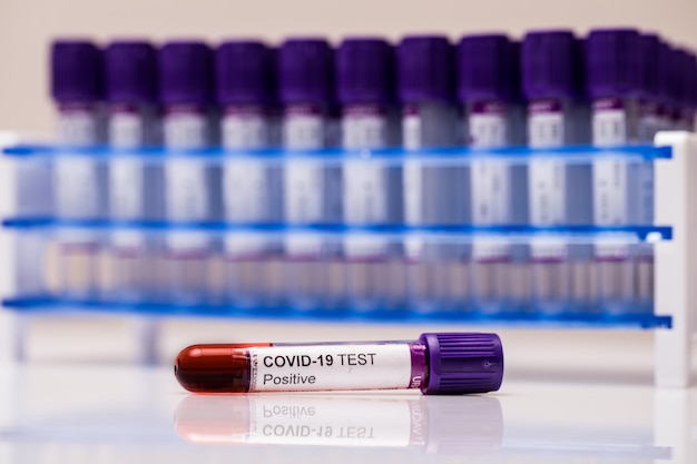 Concepto de análisis de sangre de coronavirus positivo. Análisis de muestra de sangre en tubo de ensayo para prueba de coronavirus. Tubo con sangre para la prueba 2019-nCoV o COVID-19. Concepto de análisis de sangre de coronavirus.