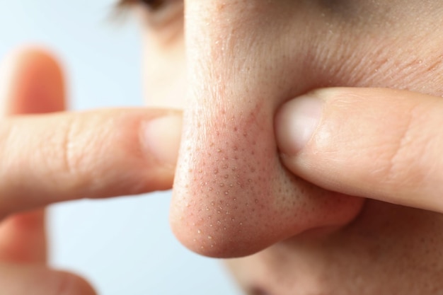 Concepto de cuidado de la piel con nariz con puntos