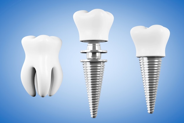 Concepto de estomatología. Implante de diente con diente sobre un fondo azul.