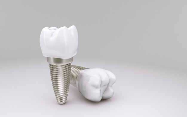 Foto concepto de implante dental en blanco