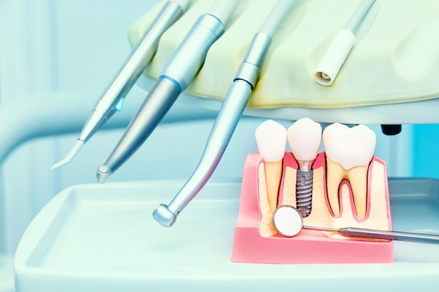 Concepto de implantología. Implantes dentales con espejo en clínica dental.