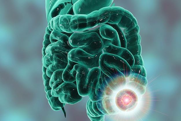 Concepto médico de concienciación sobre el cáncer colorrectal Concepto de tratamiento y prevención del cáncer Ilustración 3D