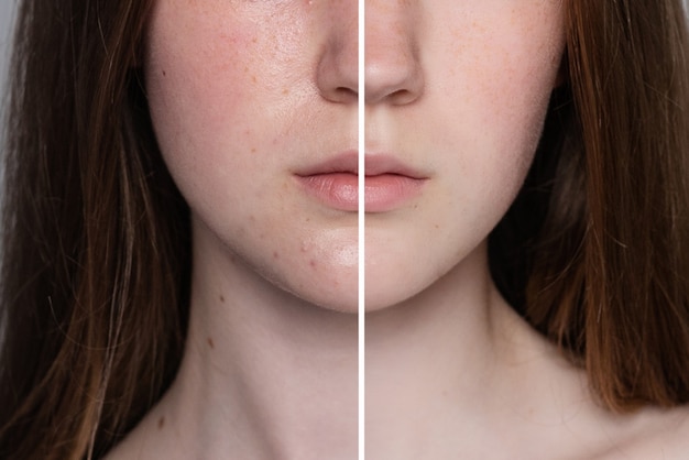 Concepto de salud, personas, juventud y belleza: antes y después de la operación cosmética. Retrato de joven mujer bonita. Antes y después de un procedimiento cosmético o plástico, terapia antienvejecimiento, tratamiento.