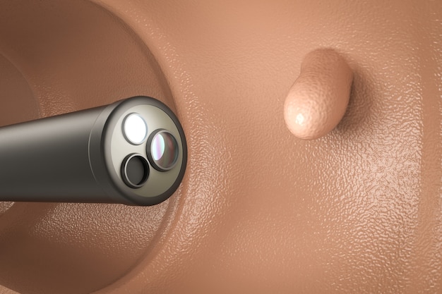 Foto concepto de tecnología de colonoscopia con endoscopio de renderizado 3d dentro del intestino con pólipo