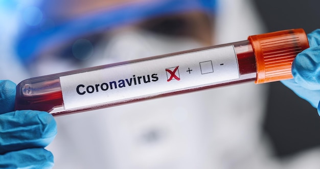 Coronavirus COVID19 Muestra de sangre infectada en médico científico Manos Epidemia y brote de virus