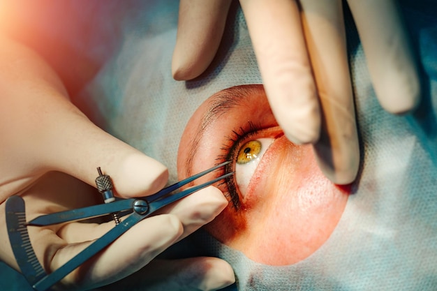 Foto corrección de la visión con láser un paciente y un cirujano en el quirófano durante la cirugía oftálmica ojo abierto paciente bajo cubierta estéril primer plano