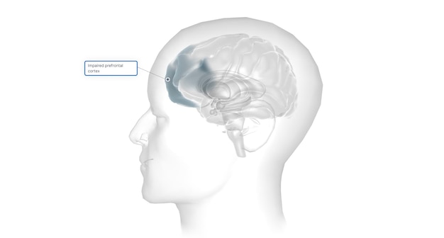 La corteza prefrontal deteriorada 3D