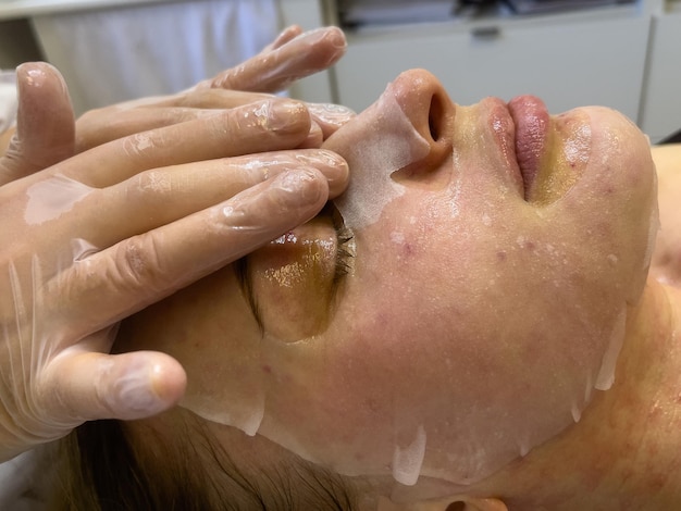 Una cosmetóloga hace una mascarilla calmante posprocedimiento después de la mesoterapia o la biorevitalización