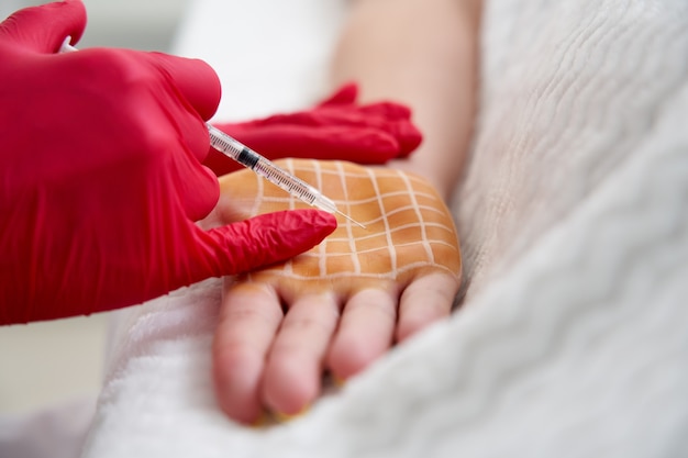 Cosmetóloga realiza inyecciones de toxina botulínica en las palmas de una mujer contra la hiperhidrosis