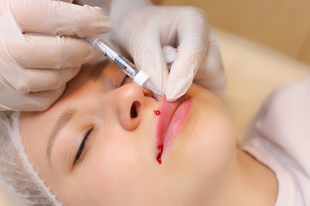 La cosmetóloga sostiene el labio superior del cliente con dos dedos, girándolo para inyectar ácido hialurónico.