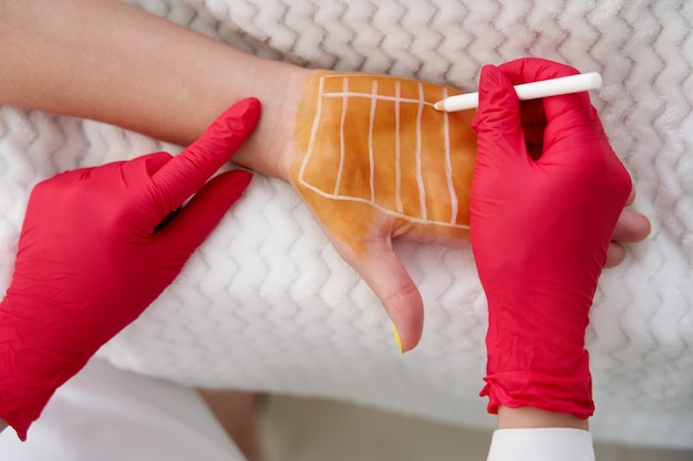 Cosmetologista faz injeções de toxina botulínica nas palmas das mãos de uma mulher contra a hiperidrose
