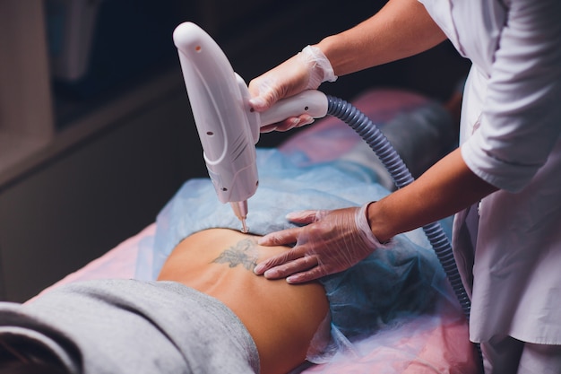 Cosmetologista fazendo laser de remoção de tatuagem profissional