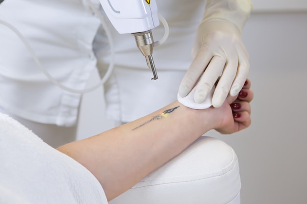 Cosmetologista fazendo remoção de tatuagem a laser