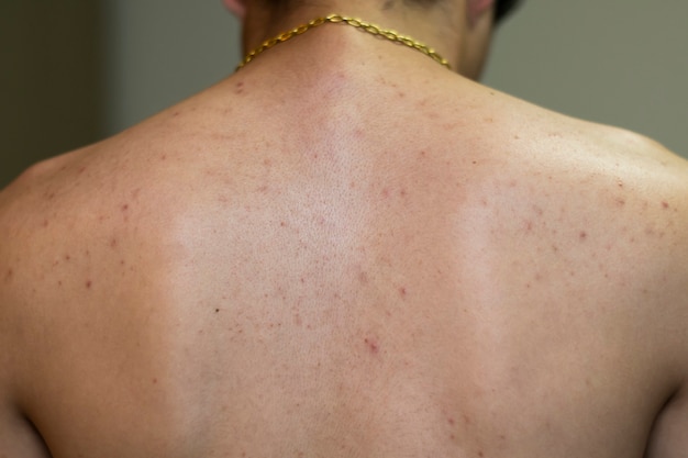 Costas de um homem com muita acne