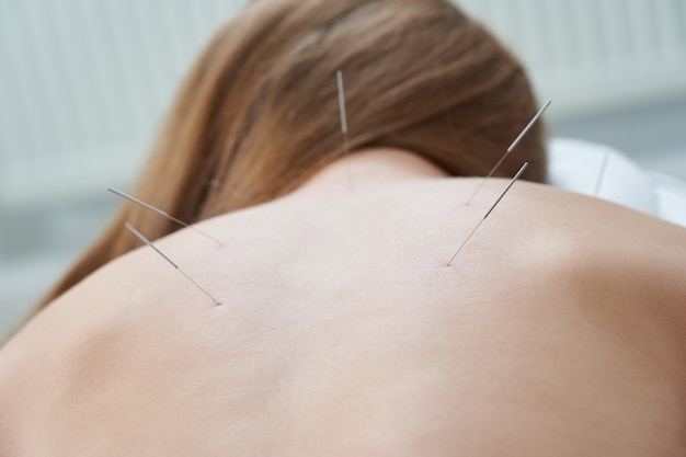 Costas femininas com agulhas no tratamento de acupuntura, terapia em salão de spa, medicina alternativa