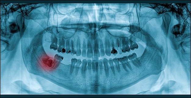 Foto creciente dolor de muelas del juicio en rayos x